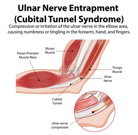 Detailed diagram of cubital tunnel syndrome