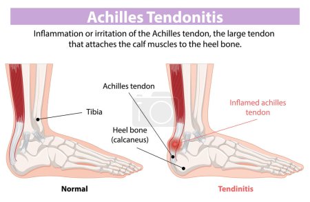 Comparaison du tendon d'Achille normal et enflammé