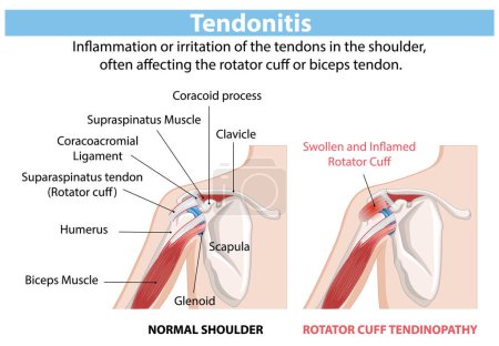 Comparaison des tendons d'épaule normaux et enflammés