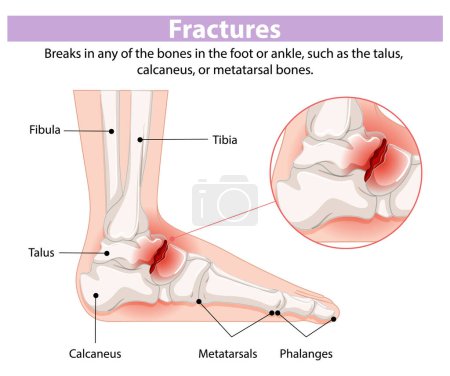 Illustration of foot and ankle bone fractures