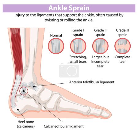 Illustration of ankle sprain grades and ligaments