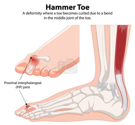 Diagram showing hammer toe deformity and anatomy