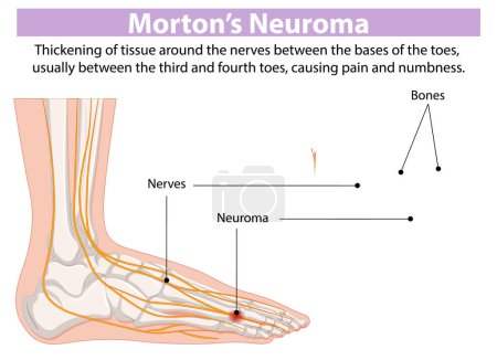 Diagrama que muestra nervios y neuroma en el pie