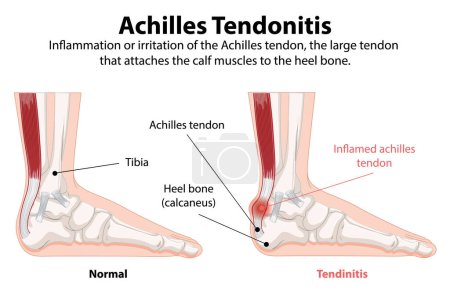 Comparaison du tendon d'Achille normal et enflammé