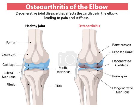 Comparison of healthy and osteoarthritic elbow joints
