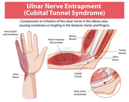 Detailed diagram of cubital tunnel syndrome