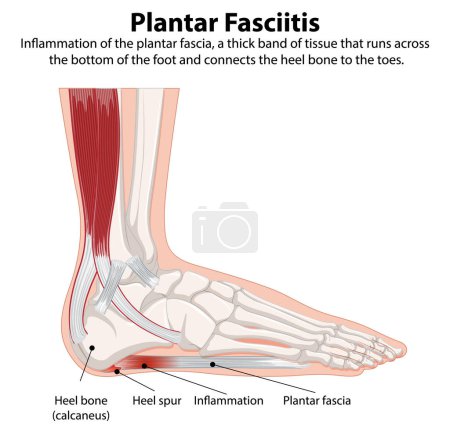 Detailed diagram of plantar fasciitis in the foot