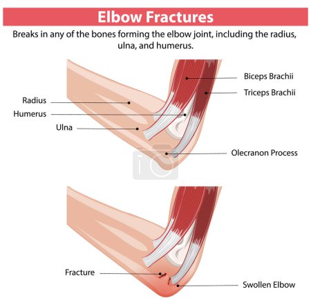 Detailed diagram of elbow fractures