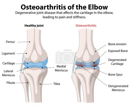 Comparación de las articulaciones del codo sanas y osteoartríticas