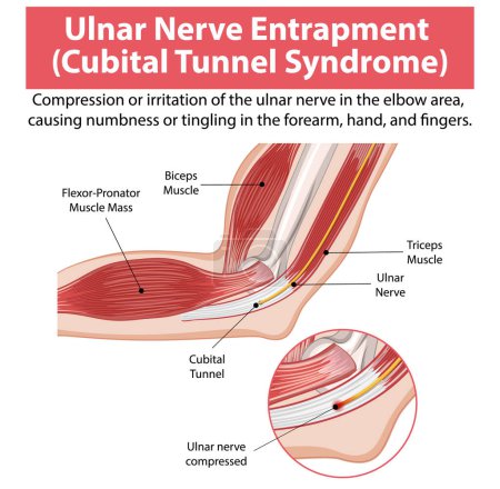 Detailed anatomy of cubital tunnel syndrome