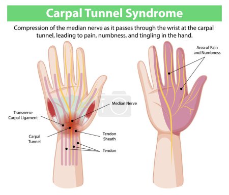 Illustration of carpal tunnel syndrome symptoms and anatomy