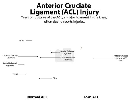Comparison of normal and torn ACL in knee