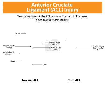 Comparison of normal and torn ACL in the knee
