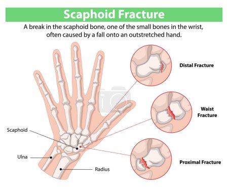 Illustration of scaphoid bone fractures in the wrist