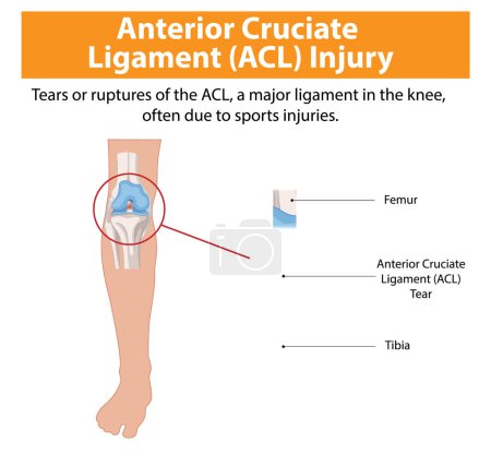 Illustration of ACL tear in the knee joint