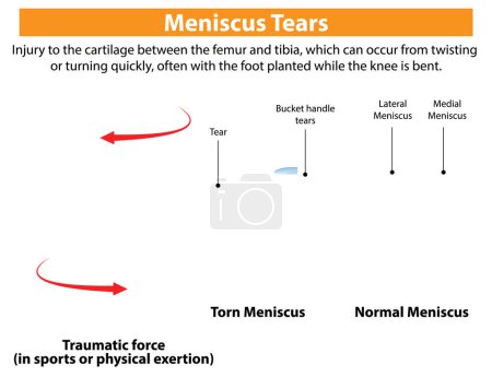 Illustration of normal and torn meniscus in knees