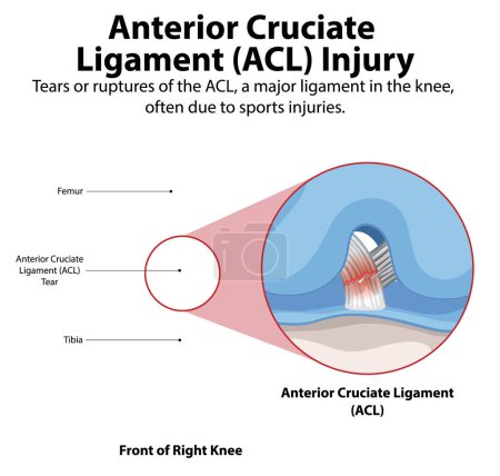 Illustration of ACL tear in the knee