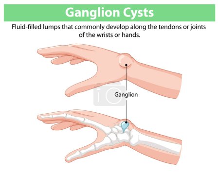 Illustration des kystes ganglionnaires sur les mains et les poignets
