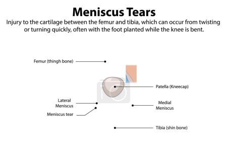 Ilustración de la anatomía del desgarro del menisco de rodilla
