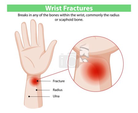 Diagram showing wrist fractures and bones