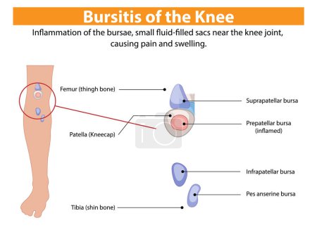 Diagram showing inflamed bursae in the knee joint
