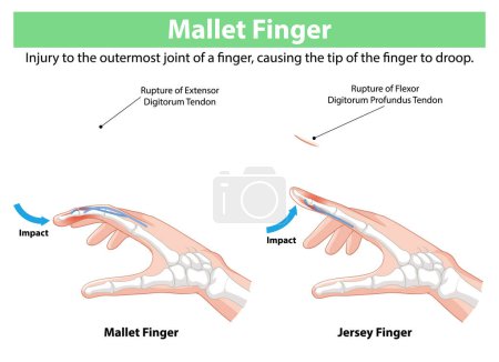 Illustration of finger tendon injuries and their impacts