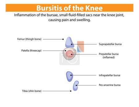 Entzündung der Kniebeuge verursacht Schmerzen und Schwellungen