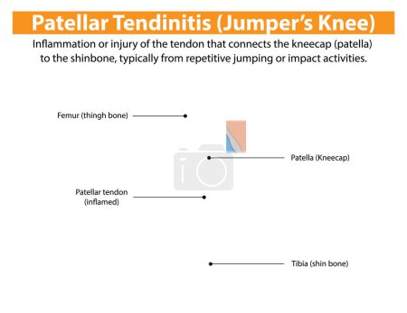 Inflammation of the patellar tendon in the knee