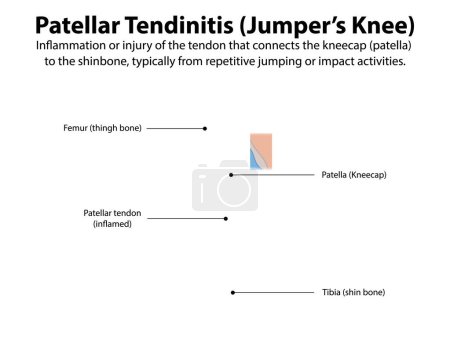 Diagram of knee showing patellar tendinitis