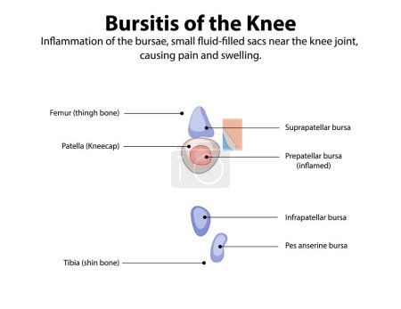 Inflammation of knee bursae causing pain and swelling