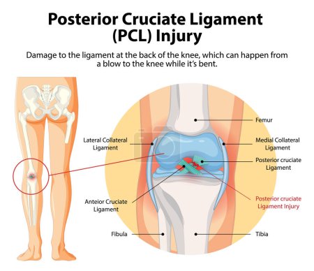 Illustration of PCL injury in the knee