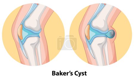 Illustration of Baker's cyst in knee joint