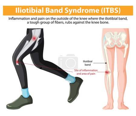 Dargestellt Knieentzündung und Schmerzen von ITBS