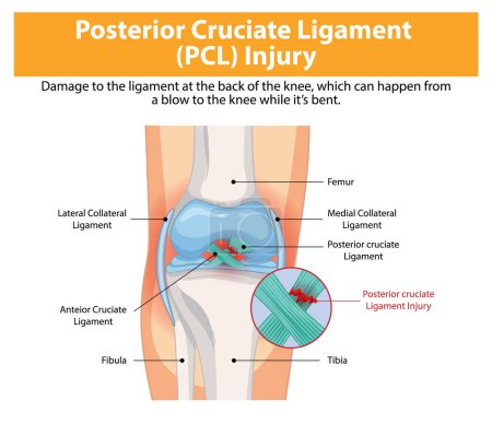 Illustration of PCL injury in the knee joint