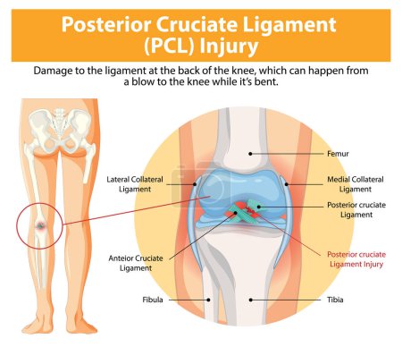 Illustration der PCL-Verletzung und der Knieanatomie