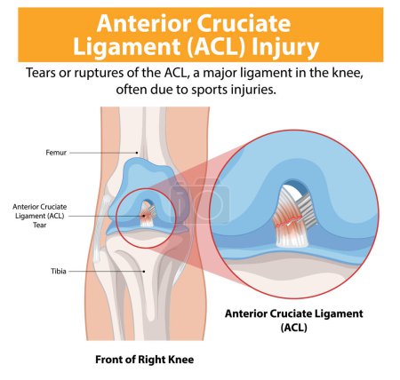 Ilustración del desgarro de LCA en la rodilla derecha