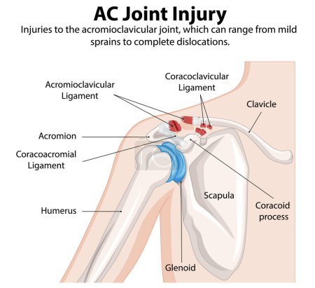 Detailed illustration of shoulder joint injury