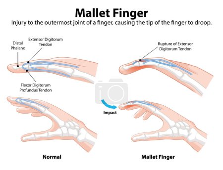 Diagrama que muestra las condiciones normales y del dedo del mazo