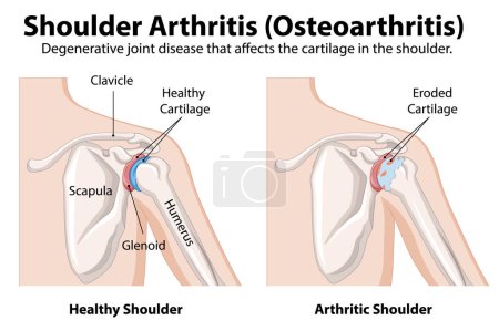 Diagrama de articulación del hombro saludable vs. artrítico