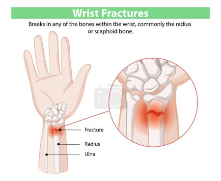 Illustration of wrist fractures and affected bones