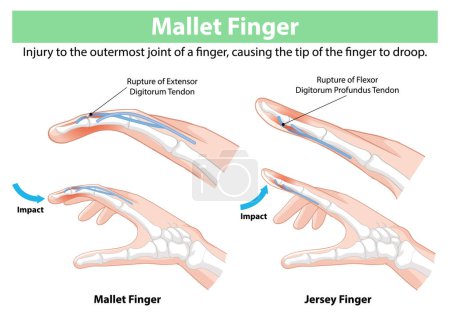 Illustration von Verletzungen der Fingersehne und Auswirkungen