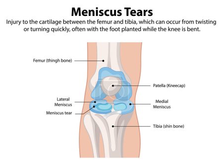 Illustration of knee meniscus tear anatomy