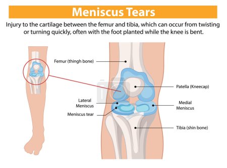 Illustration of knee meniscus tear and anatomy
