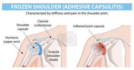 Diagram showing frozen shoulder condition and anatomy