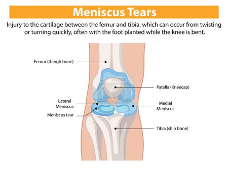 Illustration for Illustration of knee meniscus tear anatomy - Royalty Free Image