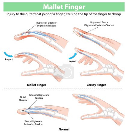 Diagrama que muestra lesiones en los dedos de mazo y jersey