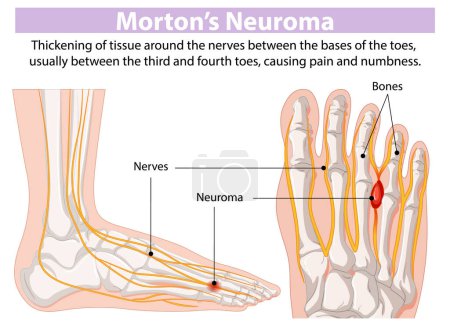Diagramme montrant l'épaississement des nerfs dans le pied