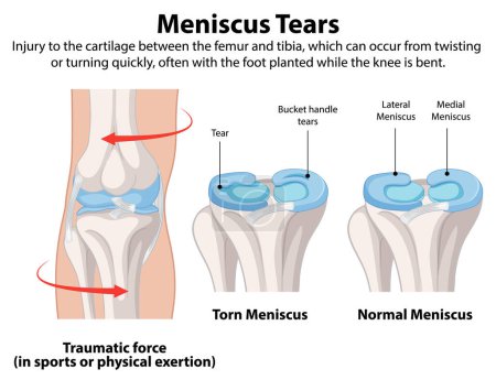Illustration of torn and normal meniscus in knee