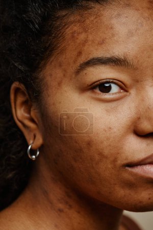 Téléchargez les photos : Plan macro vertical de cicatrices d'acné sur le visage de la jeune femme noire regardant la caméra - en image libre de droit