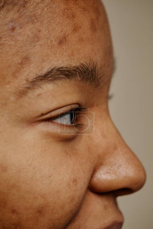 Téléchargez les photos : Macro vue de côté de jeune femme ethnique avec des cicatrices d'acné sur le visage, minime - en image libre de droit